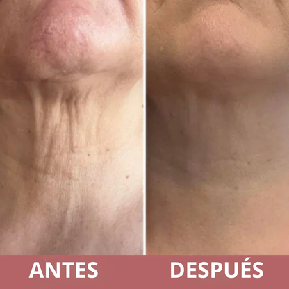 Rejuvenece Sin Cirugía - LOECARE Rolift™